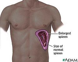 Spleen enlargement