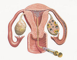 Artficial insemination